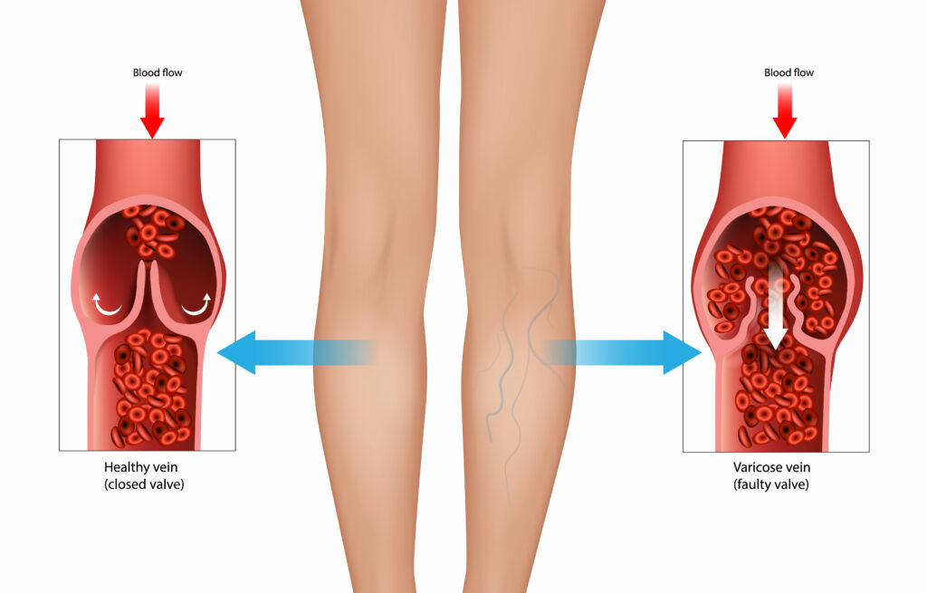 Varicose Veins Treatment in Kansas City, by Vascular & Interventional Specialists of Kansas City