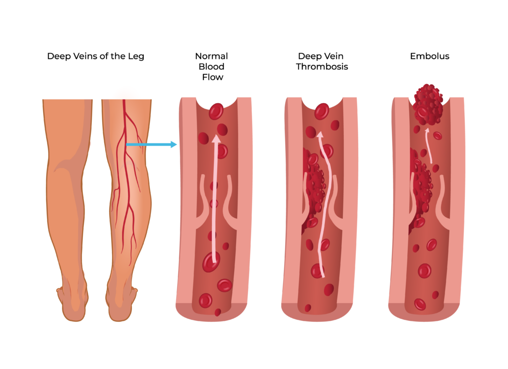 Deep Vein Thrombosis (DVT) Treatment in Kansas City, by Vascular & Interventional Specialists of Kansas City