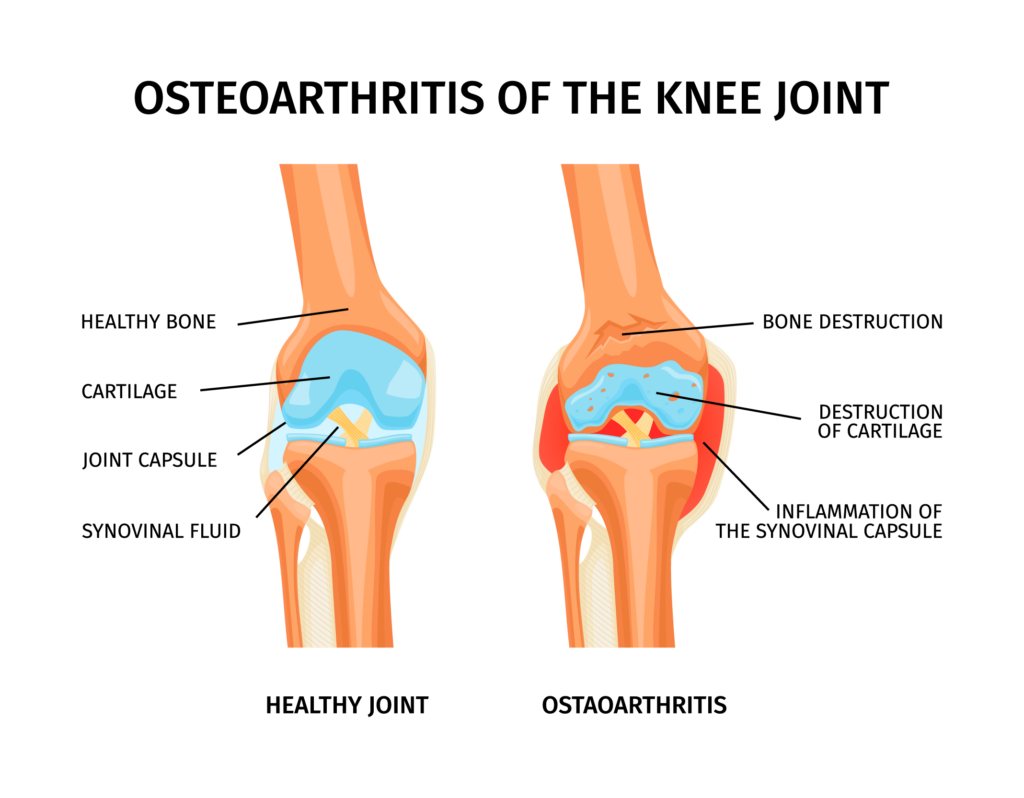 Knee Osteoarthritis Treatment in Kansas City, by Vascular & Interventional Specialists of Kansas City