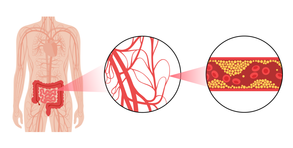Mesenteric Ischemia Treatment in Kansas City, by Vascular & Interventional Specialists of Kansas City