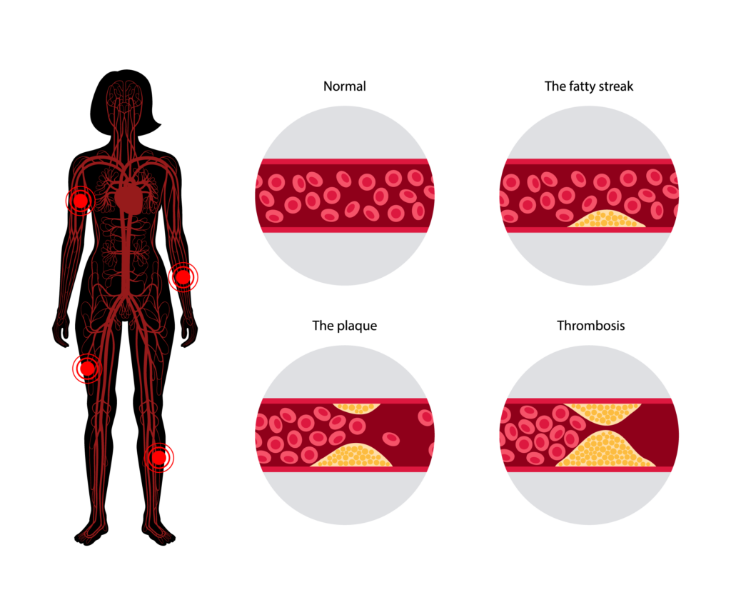 Peripheral Arterial Disease (PAD) Treatment in Kansas City, by Vascular & Interventional Specialists of Kansas City