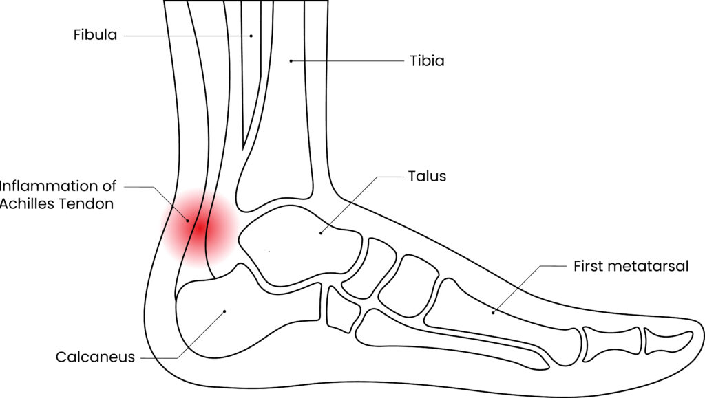 Achilles Tendinopathy Treatment in Kansas City, by Vascular & Interventional Specialists of Kansas City