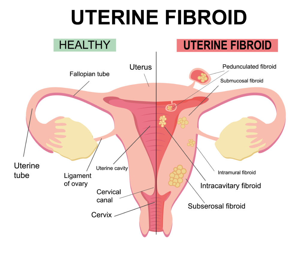 Uterine Fibroid Treatment in Kansas City, by Vascular & Interventional Specialists of Kansas City