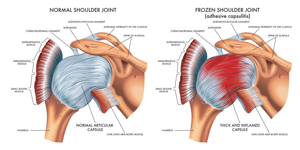 Frozen Shoulder Treatment in Kansas City, by Vascular & Interventional Specialists of Kansas City