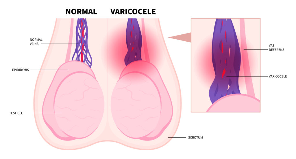 Varicocele Treatment in Dakota Dunes, by Vascular & Interventional Specialists of Dakota Dunes