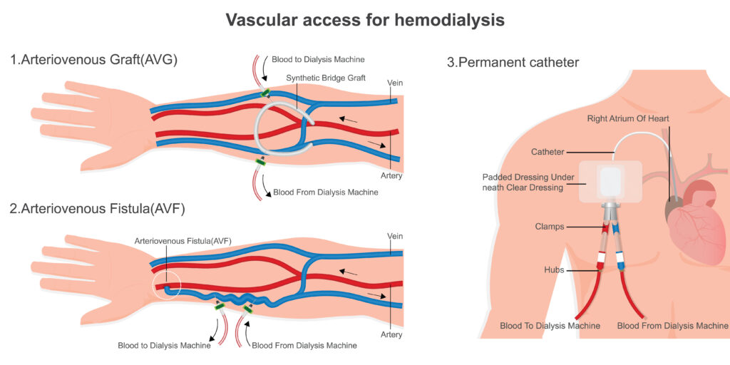 Dialysis Access in Vascular & Interventional Specialists of Kansas City