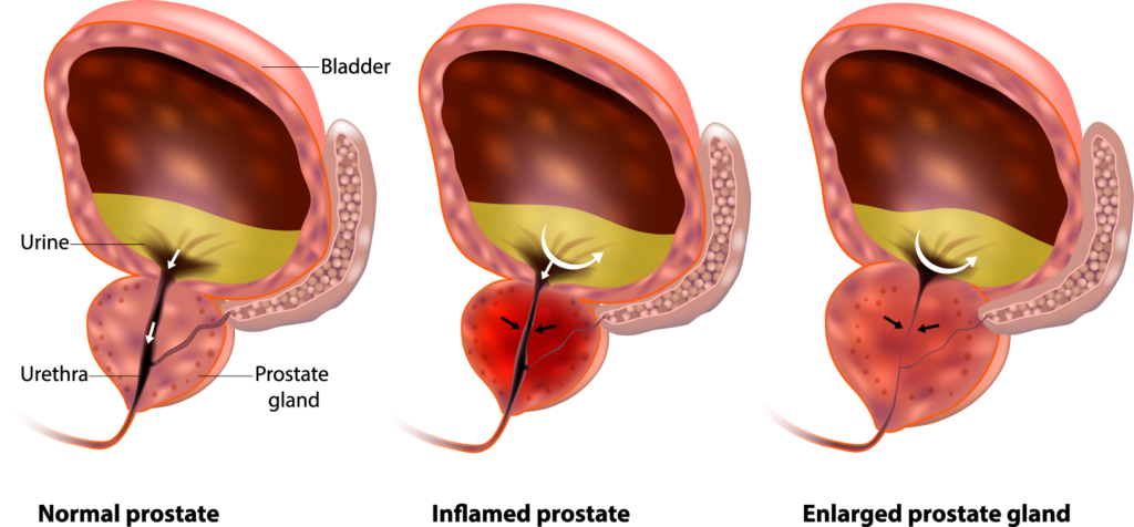 Enlarged Prostate Treatment in Kansas City, by Vascular & Interventional Specialists of Kansas City