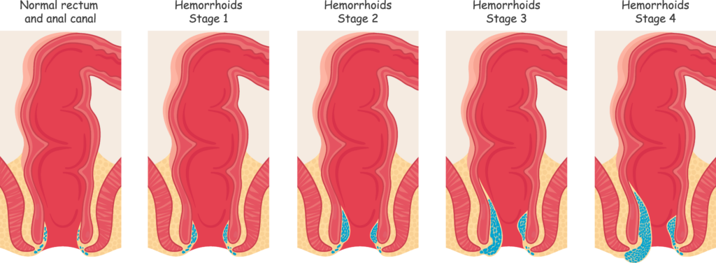 Hemorrhoids in Kansas City, by Vascular & Interventional Specialists of Kansas City