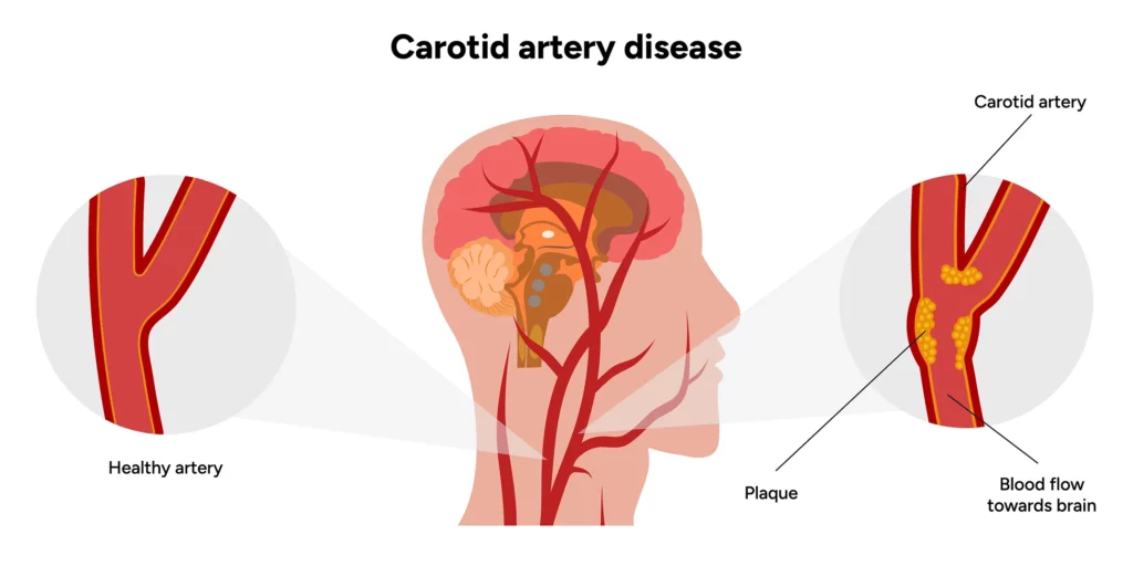 Vascular & Interventional Specialists of Kansas City